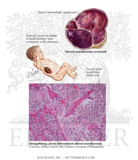 Watermarked preview of labeled image: Overview of Neuroblastoma