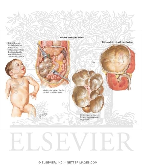 Watermarked preview of labeled image: Unilateral Multicystic Kidney