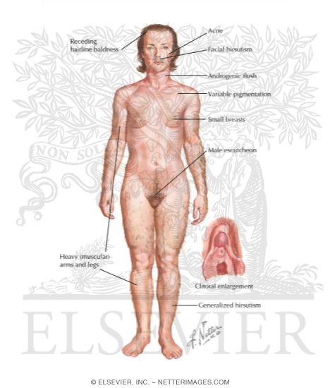 Signs and Symptoms of Congential Adrenal Hyperplasia In a Female