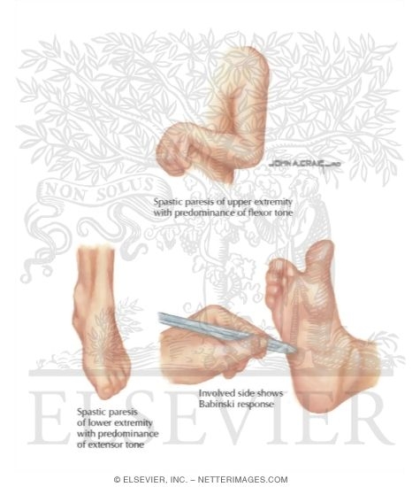 Watermarked preview of labeled image: Characteristic Pattern In Spastic Limbs