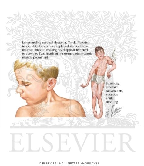 Dyskinetic Cerebral Palsy