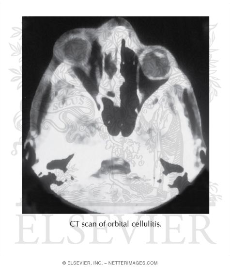 Orbital Cellulitis