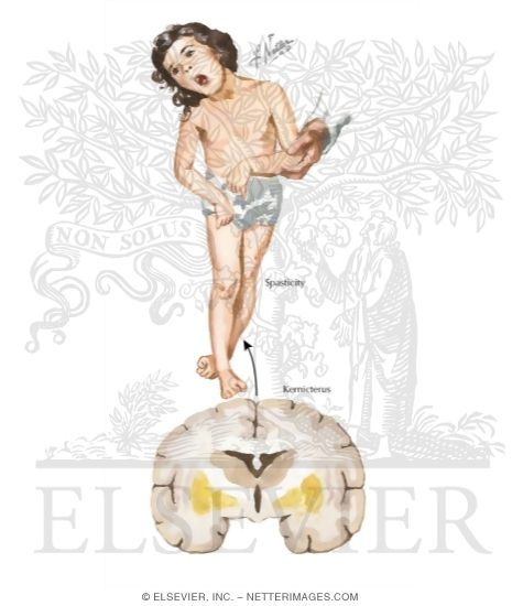 Watermarked preview of labeled image: Kernicterus