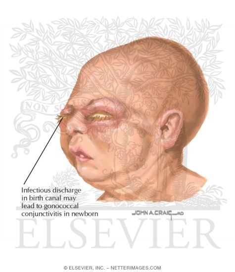 Watermarked preview of labeled image: Gonococcal Ophthalmia