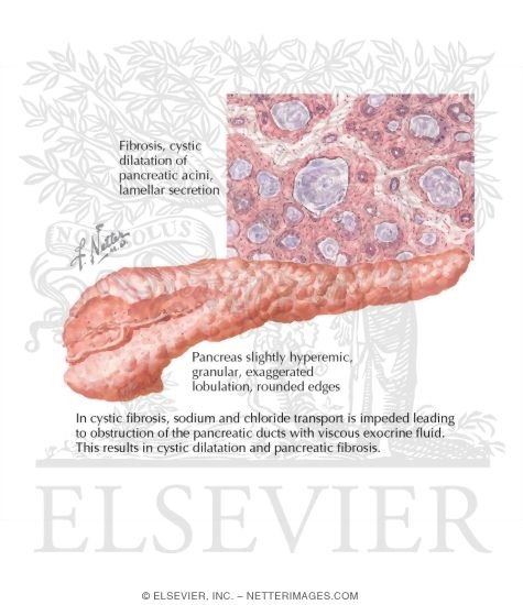 Watermarked preview of labeled image: Pancreatic Disease In Cystic Fibrosis