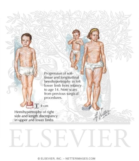 Watermarked preview of labeled image: Hemihypertrophy: Limb Length Discrepancy