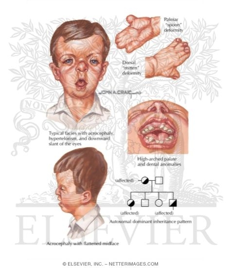 Apert Syndrome