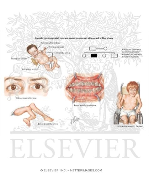 Osteogenesis Imperfecta