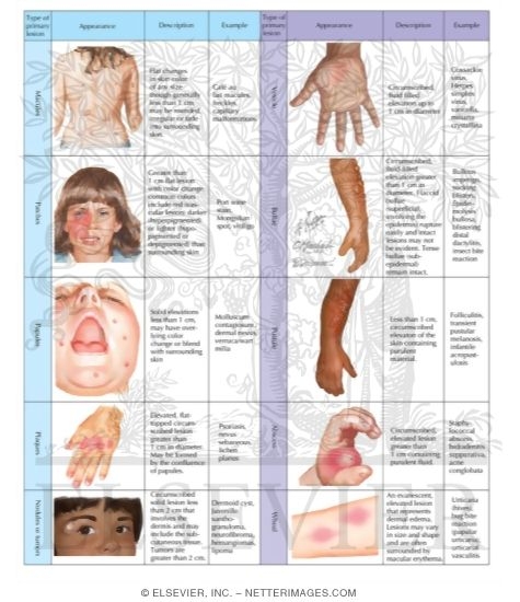 Watermarked preview of labeled image: Primary Lesions