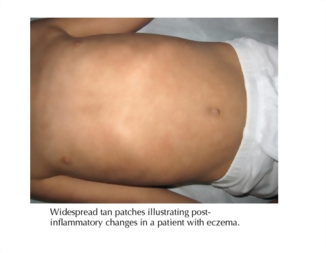 Post Inflammatory Hyperpigmentation