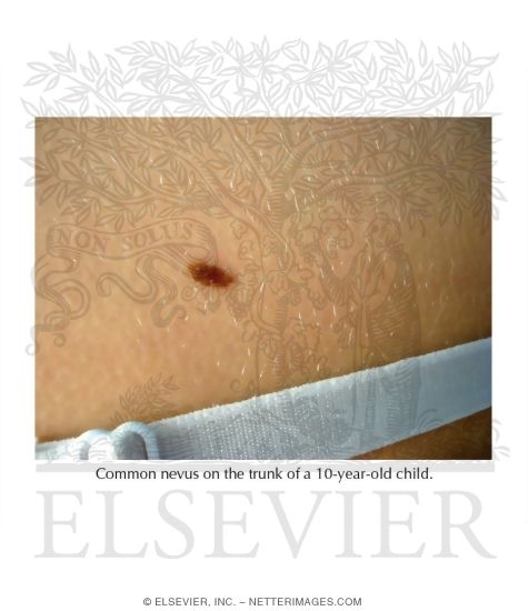 Common Nevus