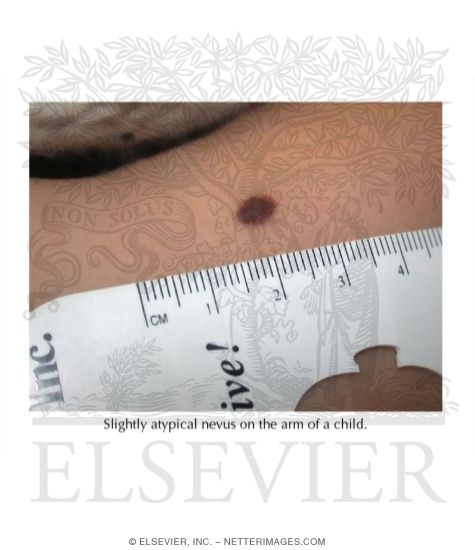 Watermarked preview of labeled image: Dysplastic Nevus