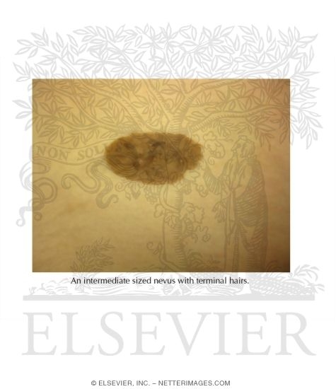 Congenital Nevus (Medium Sized)