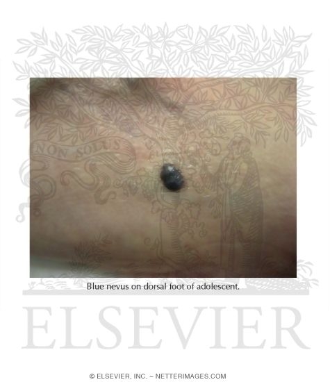 Blue Nevus