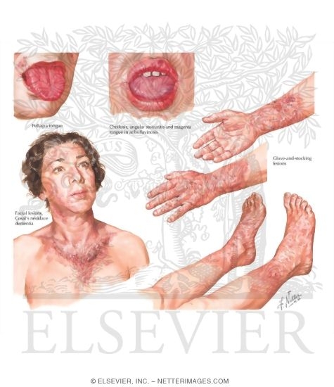 Niacin Deficiency (Pellagra)