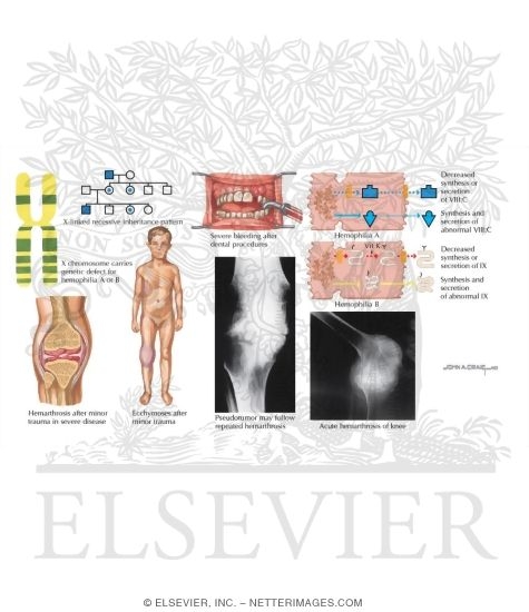 Watermarked preview of labeled image: Hemophilia A and B