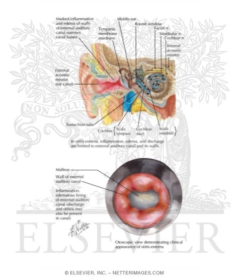 Acute Otitis Externa