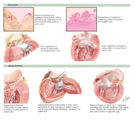 Watermarked preview of labeled image: Bacterial Endocarditis