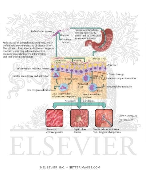 Watermarked preview of labeled image: Etiology and Pathogenesis of Helicobacter Pylori Infection