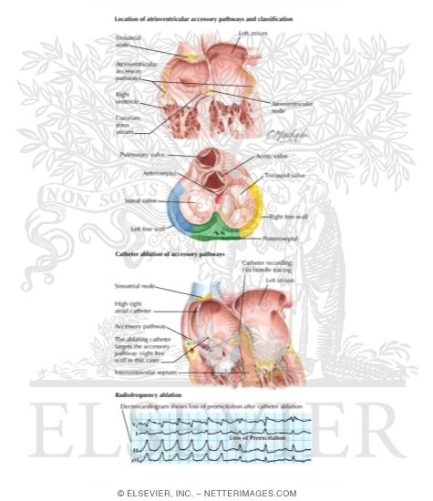 Watermarked preview of labeled image: Accessory Pathways and the Wolff - Parkinson - White Syndrome