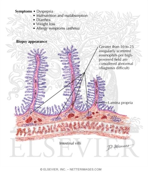Watermarked preview of labeled image: Eosinophilic Gastroenteritis