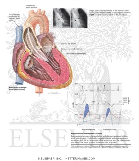 Aortic Balloon Valvuloplasty