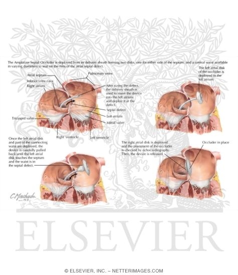 Watermarked preview of labeled image: Amplatzer Septal Occluder