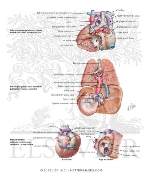 Anomalous Pulmonary Venous Connection
