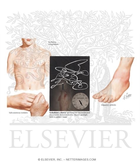 Rheumatic Fever; Sydenham's Chorea