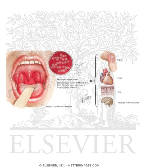 Watermarked preview of labeled image: Rheumatic Fever; Sydenham's Chorea