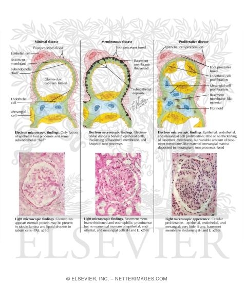 Pathology of the Nephrotic Syndrome
