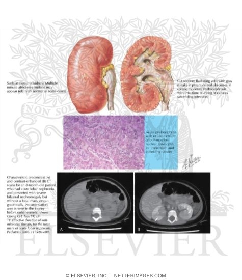 Watermarked preview of labeled image: Acute Pyelonephritis: Pathology