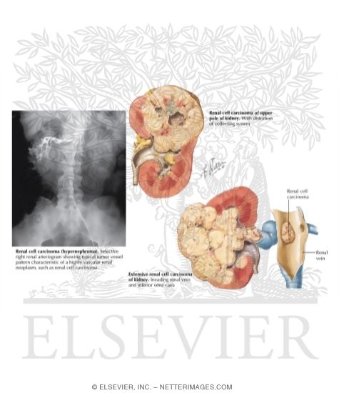 Watermarked preview of labeled image: Malignant Tumors of the Kidney