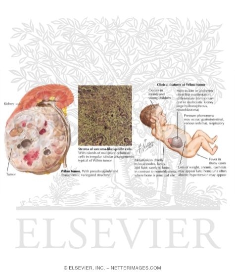 Nephroblastoma (Wilms' Tumor)
