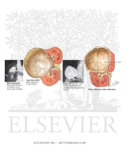 Solitary Cysts of the Kidney