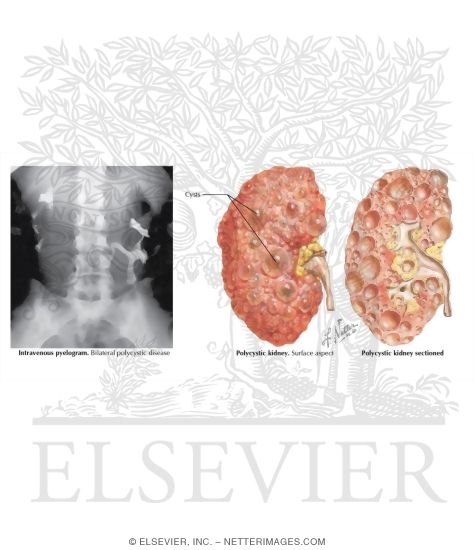 Renal Cystic Diseases