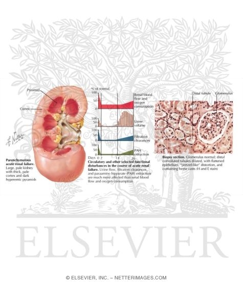 Acute Renal Failure