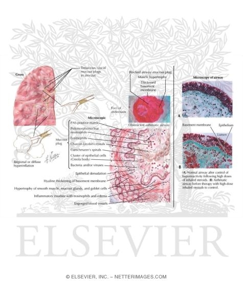 Watermarked preview of labeled image: Pathology of Status Asthmaticus
Pathology of Asthma