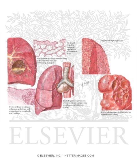 Watermarked preview of labeled image: Congenital Bronchogenic and Pulmonary Cysts
