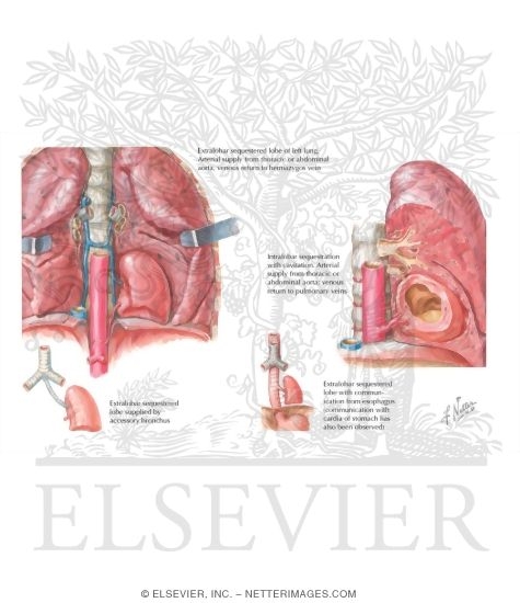 Watermarked preview of labeled image: Bronchopulmonary Sequestration