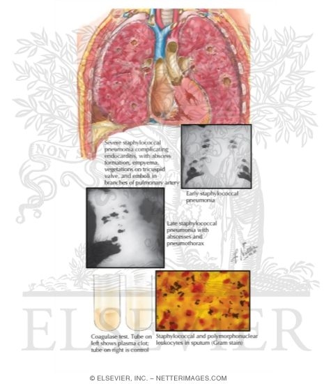 Watermarked preview of labeled image: Staphylococcal Pneumonia
