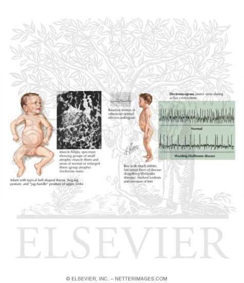 Werdnig-Hoffmann Disease