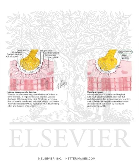 Watermarked preview of labeled image: Myasthenia Gravis: Etiologic and Pathophysiologic Concepts
