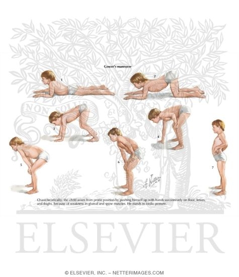 Duchenne's Muscular Dystrophy