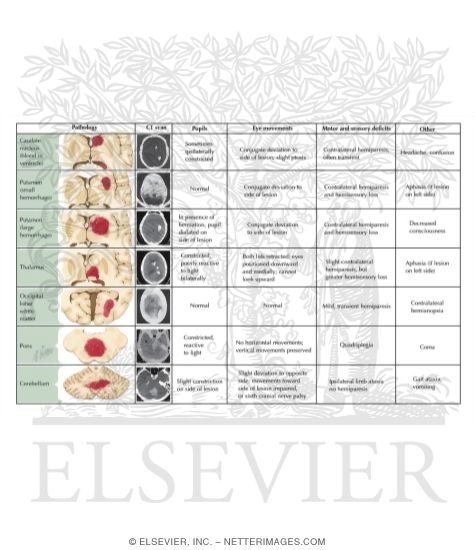 Watermarked preview of labeled image: Intracerebral Hemorrhage: Clinical Manifestations Related to Site