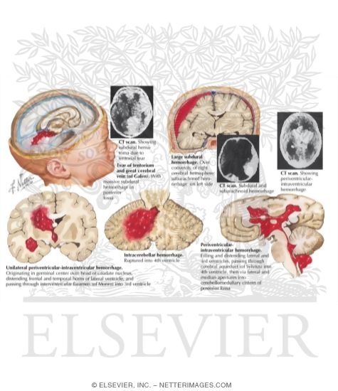 Intracranial Hemorrhage in Newborn