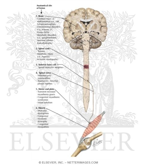Watermarked preview of labeled image: Hypotonia