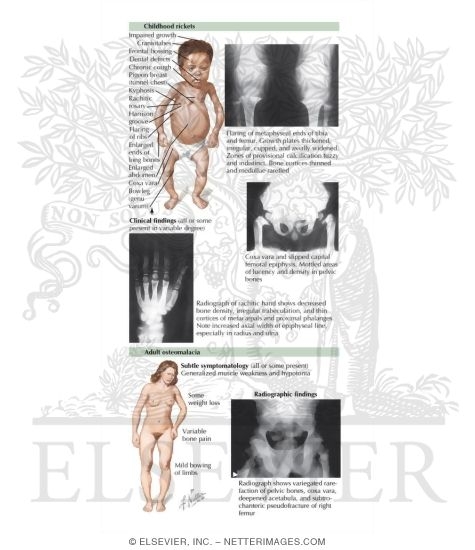 Childhood Rickets, Adult Osteomalacia