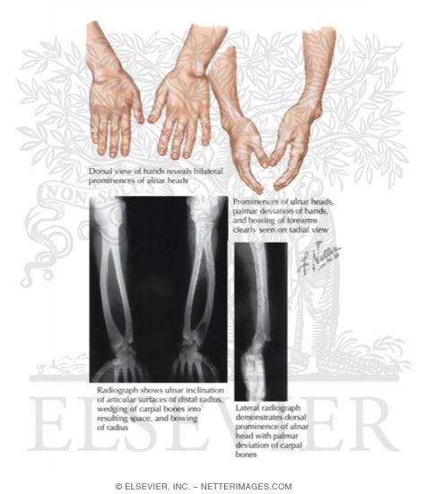 Madelung's Deformity