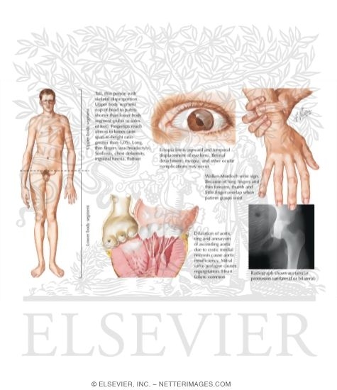 Watermarked preview of labeled image: Marfan's Syndrome